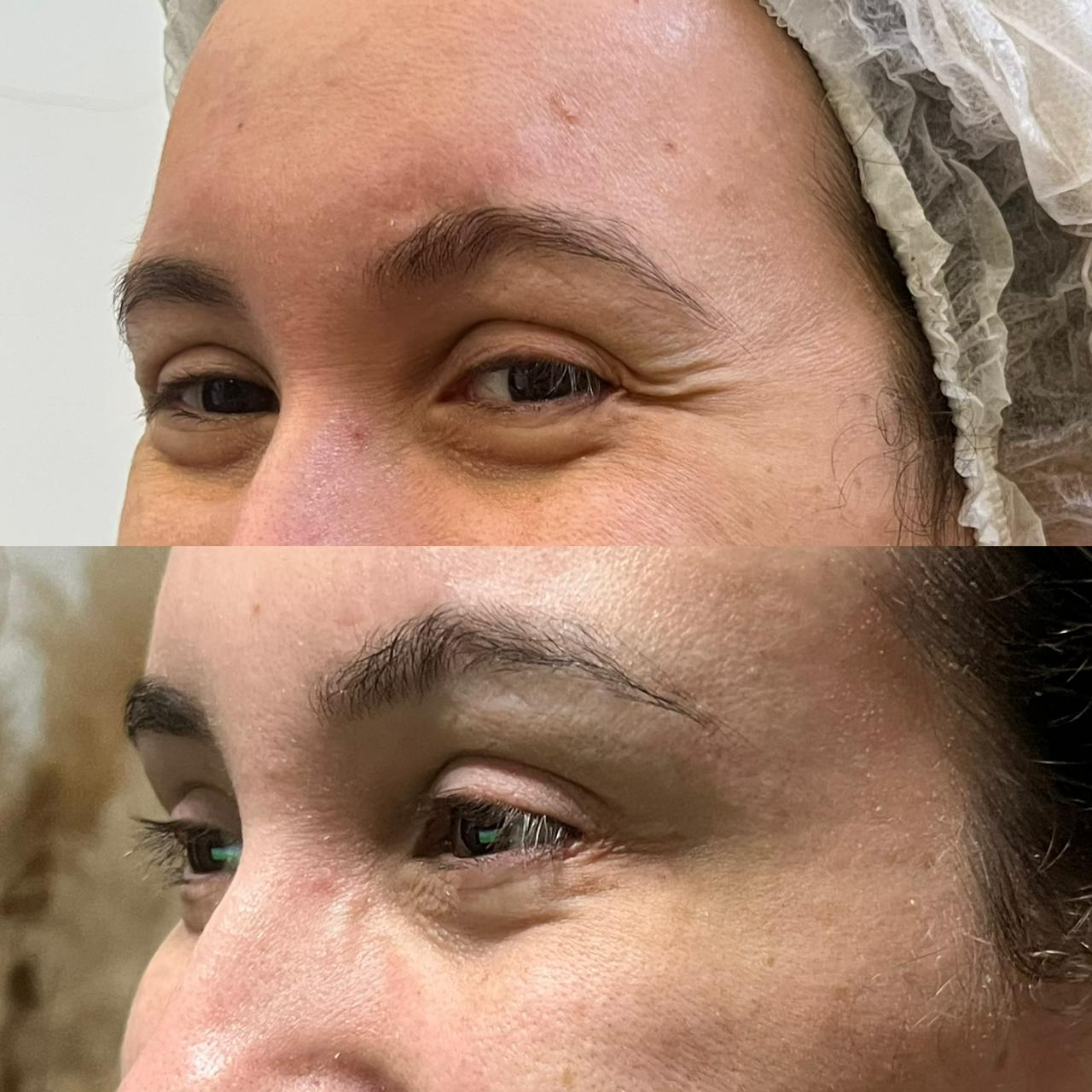 Antes e depois — Botox Olhos