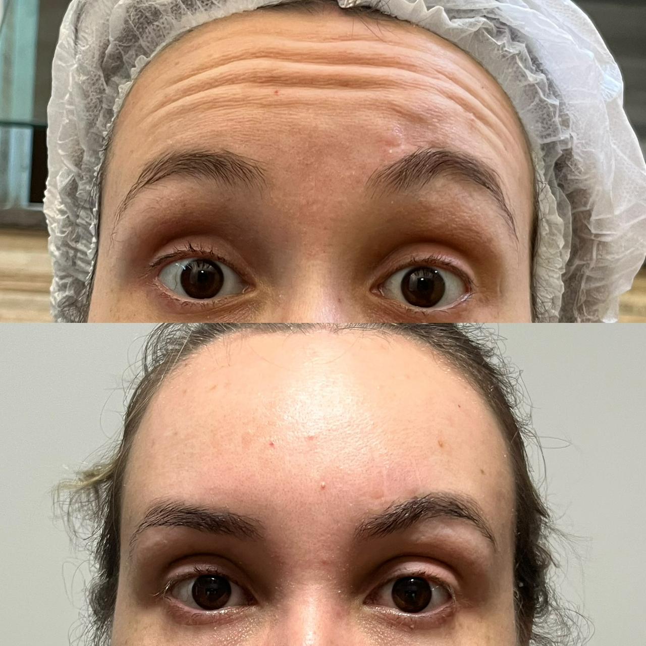 Antes e depois — Botox Testa