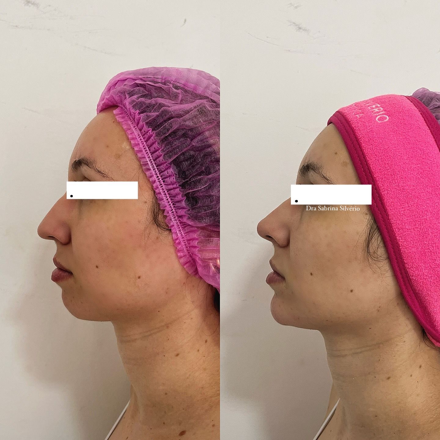 Antes e depois — Harmonização Facial