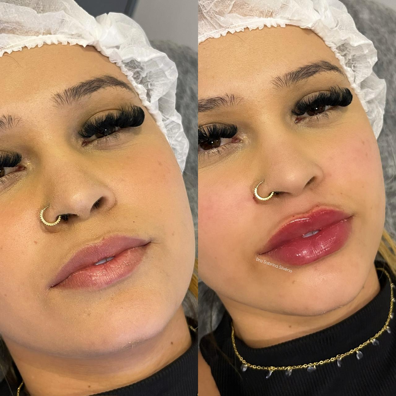 Antes e depois — Preenchimento Labial