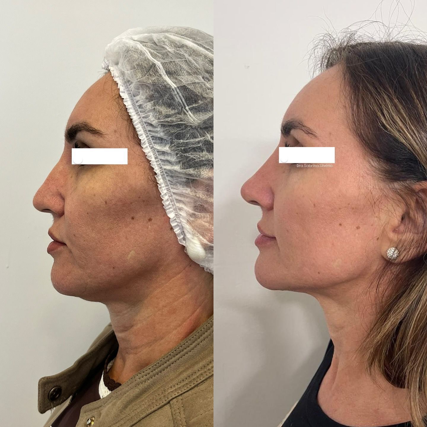 Antes e depois — Rinomodelação